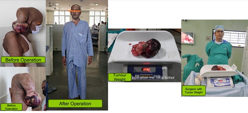  “Historic Brain Tumour Surgery: AIIMS Patna Doctor Removes 2.28 kg Growth in Record Time”