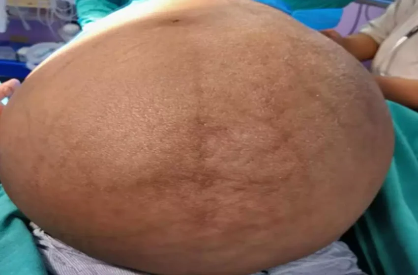  AIIMS Rishikesh Doctors Remove India’s Largest Thoracic Tumor in Landmark Surgery