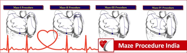  First MAZE III Surgery for Atrial Fibrillation Performed at G.B. Pant Hospital