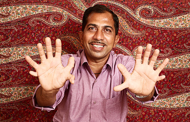  Devendra Suthar Holds World Record for Most Fingers and Toes on a Living Person