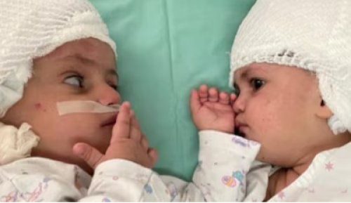  Brazilian Woman Gives Birth to Twins with Different Fathers in Rare Medical Case