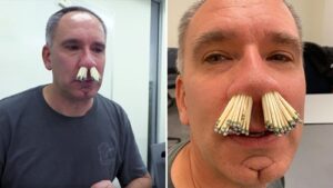 ER Doctor Wins Ironic Record for Sticking Matches Up His Nose “Luckily They Came Out”